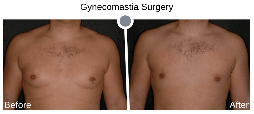 Why Are More Men Choosing Gynecomastia Surgery (Male Breast