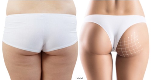 Butt implant types and sizes - Plastic Surgeon
