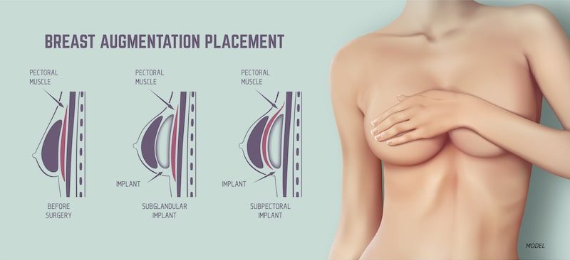 How Breast Implants Drop As You Heal